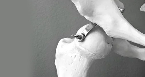 Orthopaedic model showing surgical treatment for a broken hip