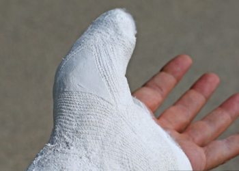 Plaster cast on a broken thumb during recovery process