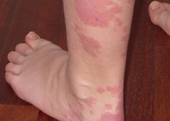 Pink and red vascular birthmarks on a person’s lower leg and foot, indicative of common types of congenital skin markings.