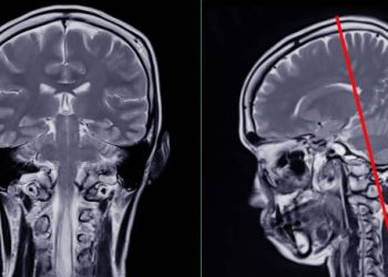 MRI scans showing structural brain abnormalities linked to Chiari malformation