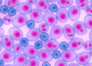 Microscopic image showing abnormal lymphocytes related to chronic lymphocytic leukaemia