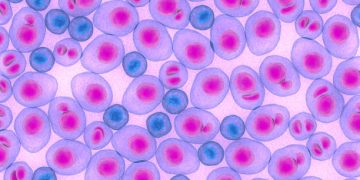 Microscopic image showing abnormal lymphocytes related to chronic lymphocytic leukaemia