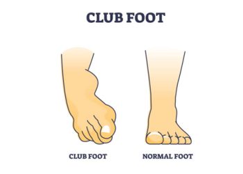 Medical illustration comparing a club foot to a normal foot