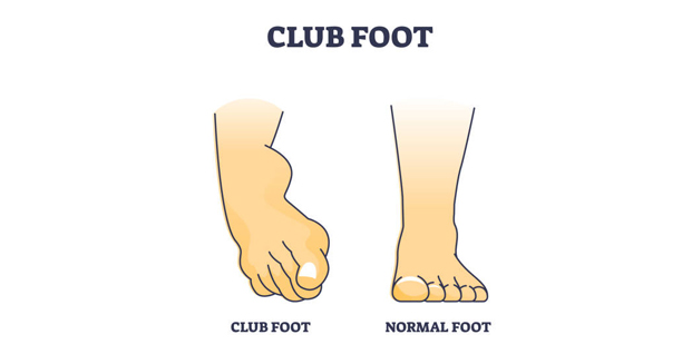 Medical illustration comparing a club foot to a normal foot