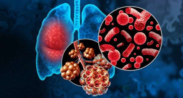Illustration showing lung infection and virus particles linked to the common cold