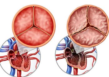 Medical illustration of normal and abnormal heart valve structures linked to congenital heart disease