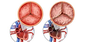 Medical illustration of normal and abnormal heart valve structures linked to congenital heart disease