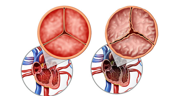 Medical illustration of normal and abnormal heart valve structures linked to congenital heart disease