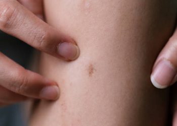 Close-up of a person's fingers scratching irritated skin, highlighting triggers of contact dermatitis.