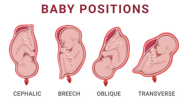 Illustration of various fetal positions in the womb, including cephalic, breech, oblique, and transverse, which may influence cranial development.