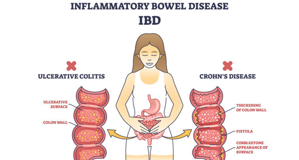 Medical illustration comparing ulcerative colitis and Crohn’s disease as forms of inflammatory bowel disease (IBD), highlighting colon wall changes and inflammation.
