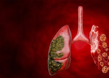 Medical illustration of lungs and trachea affected by viral infection, symbolising the causes of croup in the respiratory tract.