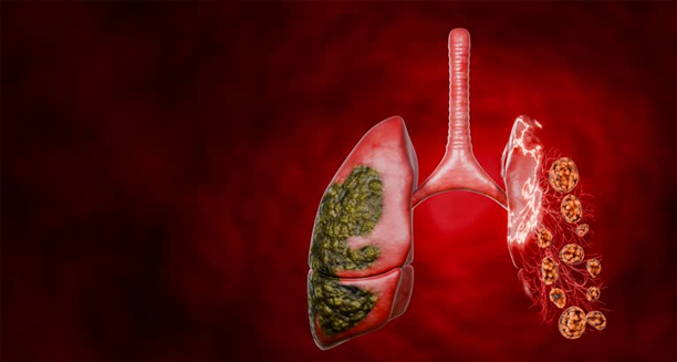 Medical illustration of lungs and trachea affected by viral infection, symbolising the causes of croup in the respiratory tract.