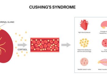 Diagram showing adrenal gland overproducing cortisol leading to symptoms of Cushing’s Syndrome.