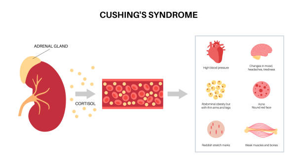 Diagram showing adrenal gland overproducing cortisol leading to symptoms of Cushing’s Syndrome.