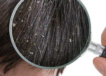 Close-up of dandruff flakes on scalp under a magnifying glass