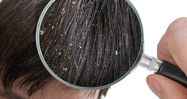 Close-up of dandruff flakes on scalp under a magnifying glass
