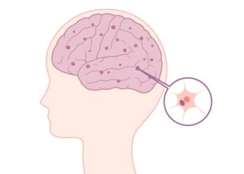Diagram of the human brain showing affected regions by Lewy bodies