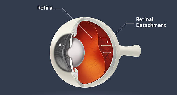 Cross-section diagram showing retinal detachment inside the eye