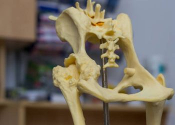 Anatomical model showing hip joint deformation