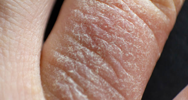 Dry, cracked skin on the hand indicating possible discoid eczema flare-up