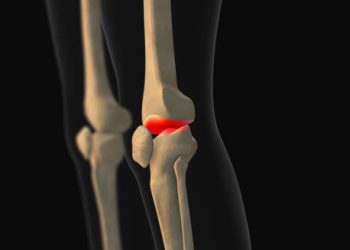 3D illustration showing dislocated kneecap in human knee anatomy