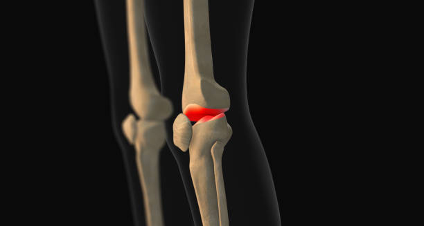 3D illustration showing dislocated kneecap in human knee anatomy