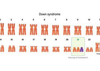 Chromosome chart showing trisomy 21 in Down’s Syndrome