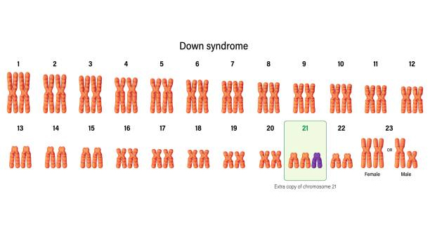 Chromosome chart showing trisomy 21 in Down’s Syndrome
