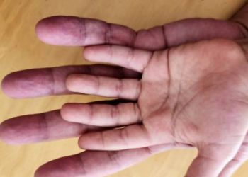 Comparison of normal and affected hands showing signs of Dupuytren’s contracture