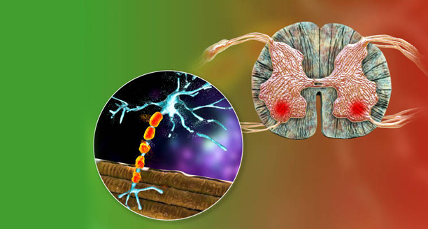 Illustration of damaged motor neurons and spinal cord cross-section