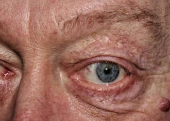 Close-up of a man's eyes showing sagging lower eyelids, a common sign of ectropion causes.
