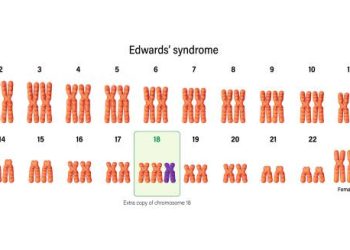 Chromosomal diagram showing Trisomy 18 as the cause of Edwards’ Syndrome.