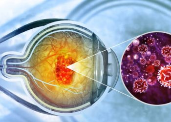 Medical illustration showing cancer cells inside the eye