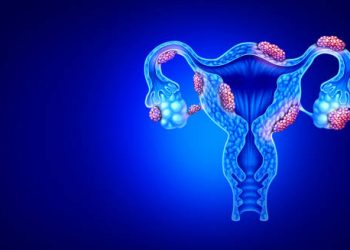 Digital illustration of fibroids in the female reproductive system