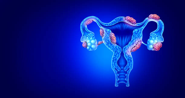 Digital illustration of fibroids in the female reproductive system