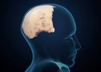 Medical illustration of Chiari malformation affecting the brain