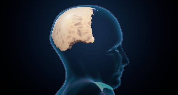 Medical illustration of Chiari malformation affecting the brain