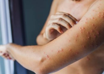 Adult with visible chickenpox rash on arm and torso