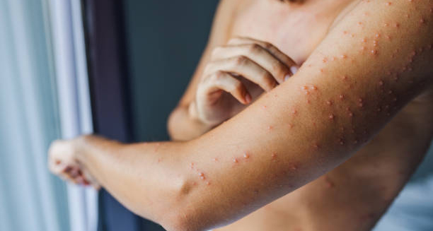 Adult with visible chickenpox rash on arm and torso