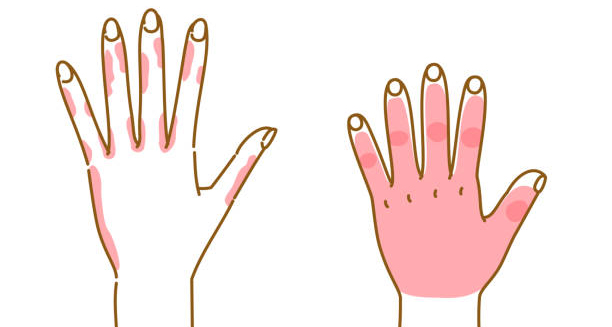 Illustration of hands with red swollen areas showing symptoms of chilblains