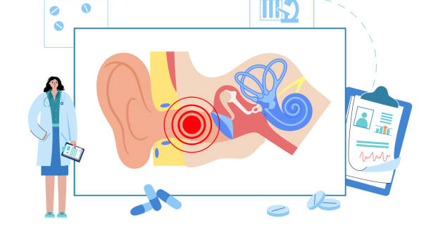 Diagram of the human ear showing cholesteatoma inside the middle ear