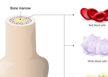Bone marrow diagram showing red and white blood cells involved in chronic lymphocytic leukaemia