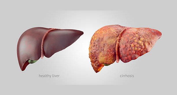 Medical comparison of a healthy liver and a liver with cirrhosis.