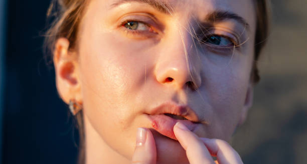 Woman touching her lip with visible cold sore