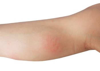 Red inflamed patch on the inner arm, indicating possible complex regional pain syndrome