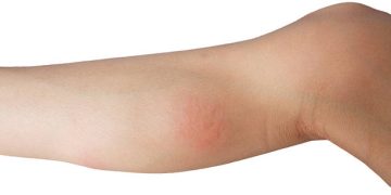 Red inflamed patch on the inner arm, indicating possible complex regional pain syndrome