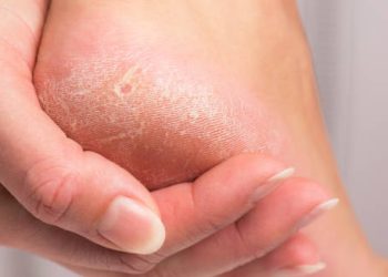 Complications and Recovery from Calluses