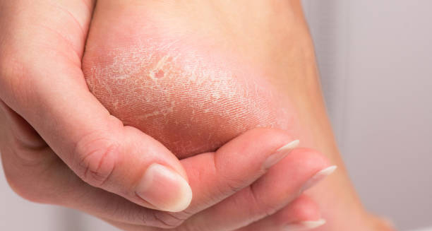 Complications and Recovery from Calluses