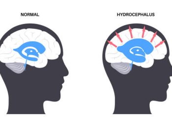 Chiari malformation complications with hydrocephalus illustration